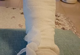 骨科医生在线问诊跖骨骨折怎么办(脚大拇指骨折医生不给打石膏怎么办)