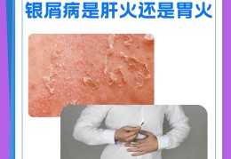 妈妈后天得银屑病会遗传吗(妈妈有银屑病会遗传吗)